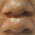 Detox gel deep pore treatment